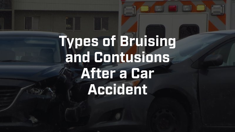 Types of Bruising and Contusions After a Car Accident